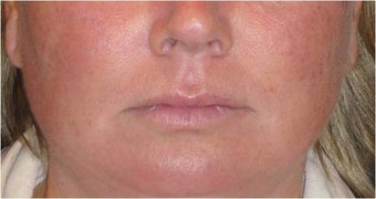 Juvederm before 686402