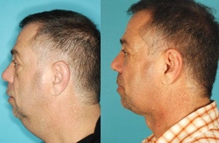 Chin and Neck before 662844