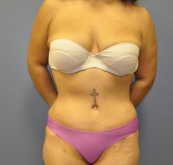 Hourglass Tummy Tuck by Dr. Wilberto Cortes after 472640