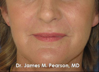 Perioral Rejuvenation after 910412