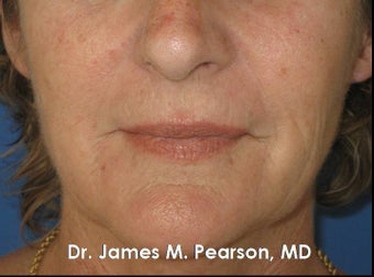 Perioral Rejuvenation before 910412
