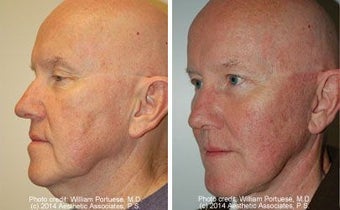 Facelift before 91469