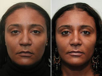African American Rhinoplasty before 44101