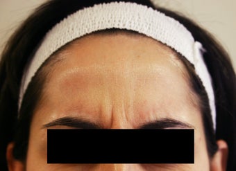 Botox before 1010793