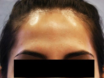 Botox after 1010793