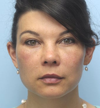 Facial Dermafillers after 1001787