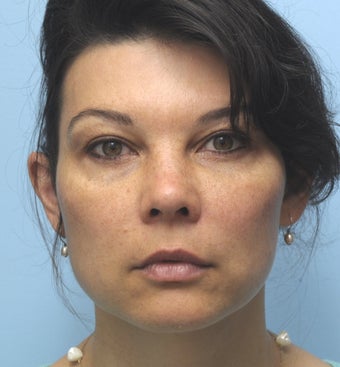 Facial Dermafillers before 1001787