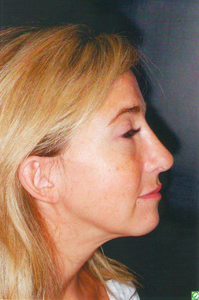 Revision Rhinoplasty after 923070