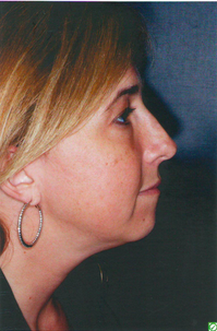 Revision Rhinoplasty before 923070