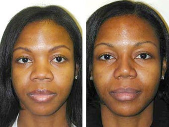 African American Rhinoplasty before 43803