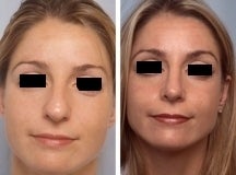 Rhinoplasty before 143646