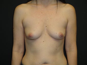 Implant-based breast reconstruction before 867387