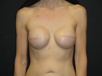 Implant-based breast reconstruction after 867387