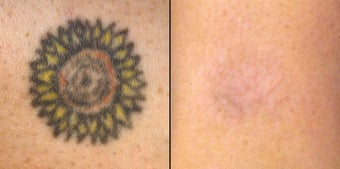 PicoSure before 1006787
