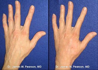 Hand Rejuvenation before 910413