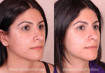 Revision Rhinoplasty before 681874