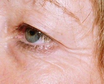 Laser Resurfacing of Crows Feet Skin before 1174471