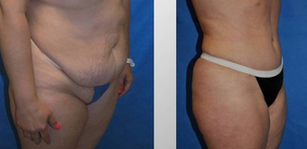 Tummy Tuck (Abdominoplasty) before 258051