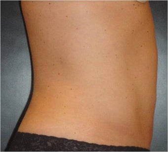 SmartLipo after 686078