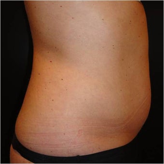 SmartLipo before 686078