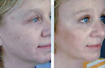 Complete Facial Rejuvenation after 138168