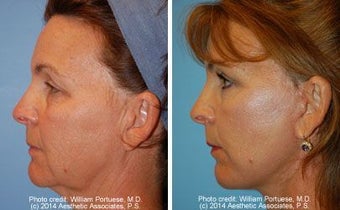Facelift before 91426