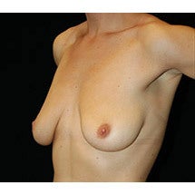 Breast LIft and Implants before 662444