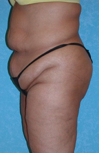 Circumferential Body Lift before 857149