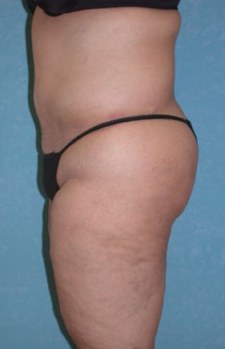 Circumferential Body Lift after 857149