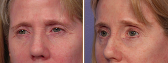 Eyelid Surgery before 271163