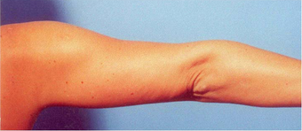Arm Liposuction after 652123