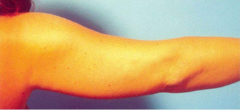 Arm Liposuction before 652123