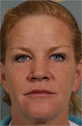 46 year old female with crows feet, loss of lip volume with smokers lines, heaviness of upper eye lids after 821871