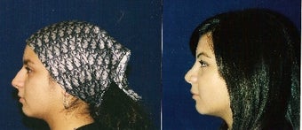 Rhinoplasty before 229755