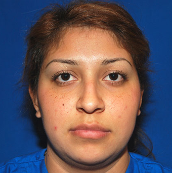 Rhinoplasty before 1357426