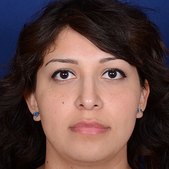Rhinoplasty after 1357426