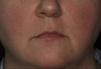 Female Treated for Rosacea/Photoaging after 772032