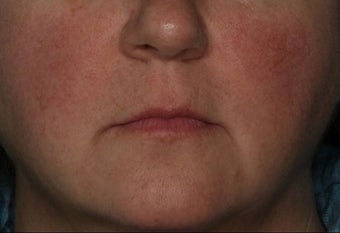 Female Treated for Rosacea/Photoaging before 772032