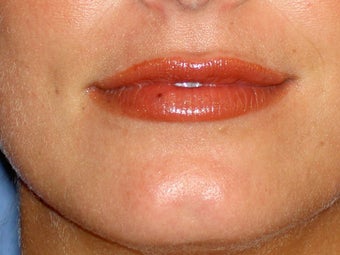 Before lip filler after 91241