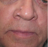 mole removal before 903577