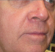 mole removal after 903577