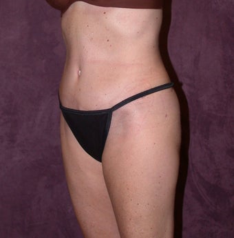 Tummy tuck (abdominoplasty) with liposuction of hips after 94647