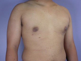 Male Breast Reduction after 285189