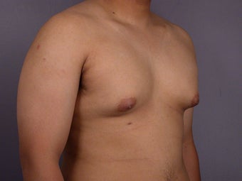 Male Breast Reduction before 285189