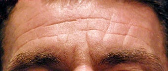 Botox for Men before 124031