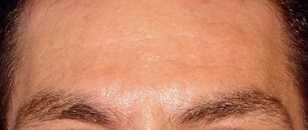 Botox for Men after 124031