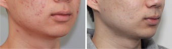 Buccal Fat Before and 2 Month After after 887612