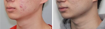 Buccal Fat Before and 2 Month After before 887612