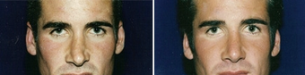 Non-surgical Rhinoplasty, Before and After before 813437