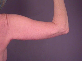 Arm Lift after 281288